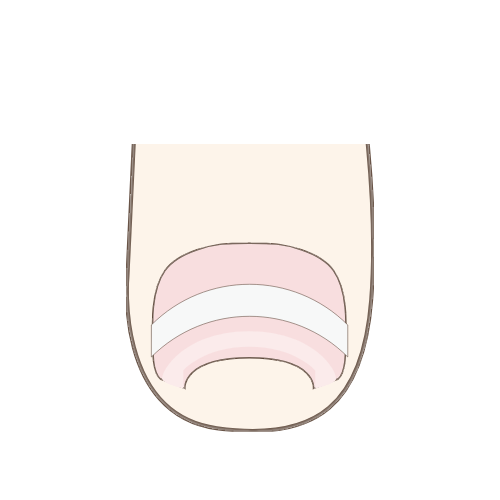 透明プレート補正